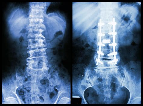 why is my spinal hardware removed